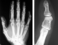 /album/galeria-de-fotos-clinodactilia/clinodactilia-png/